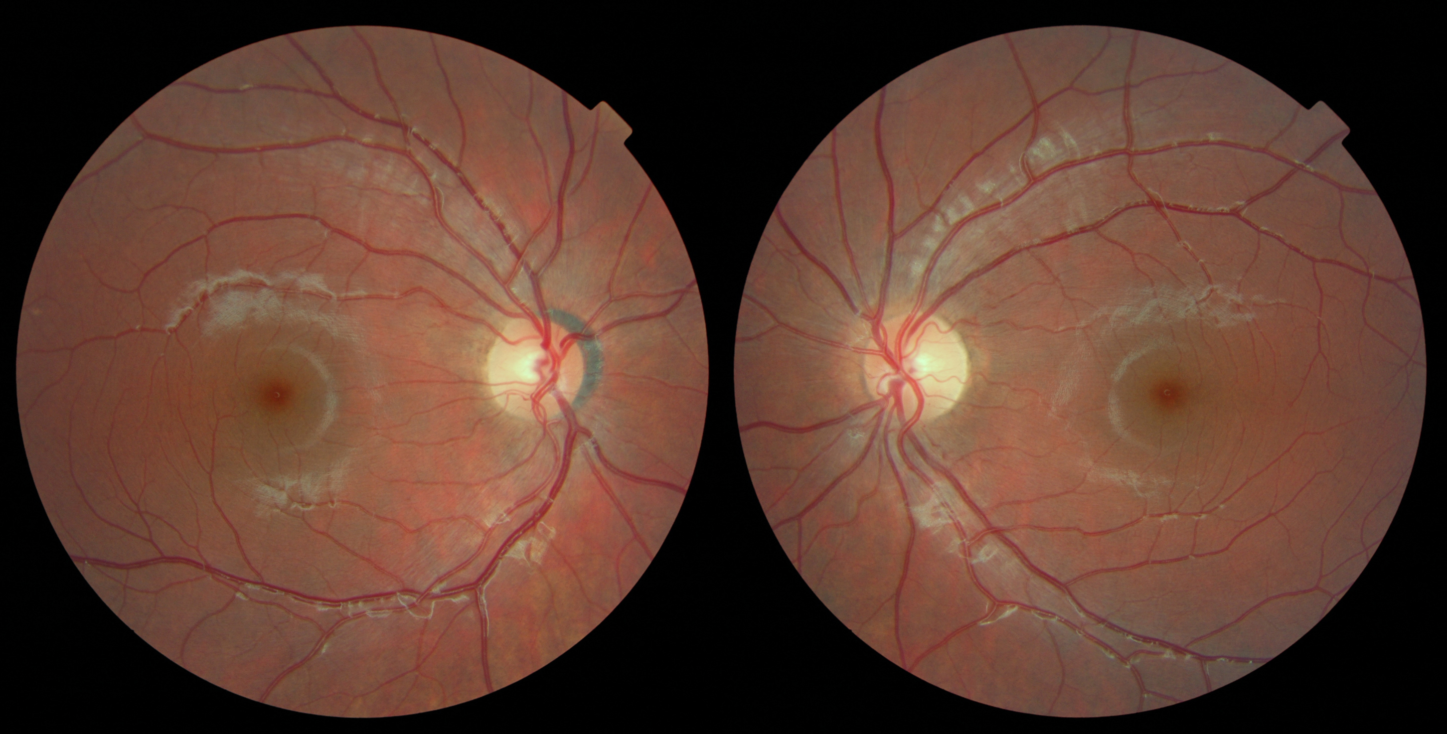 Офтальмоскопия глазного дна норма